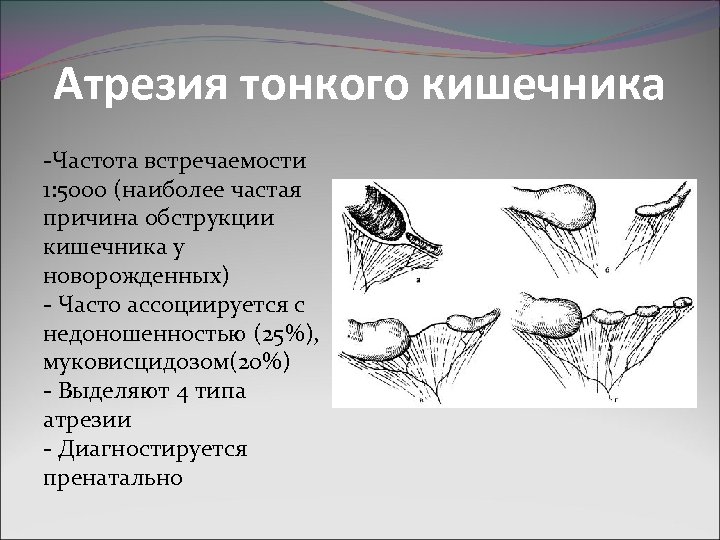 Атрезия тонкого кишечника -Частота встречаемости 1: 5000 (наиболее частая причина обструкции кишечника у новорожденных)