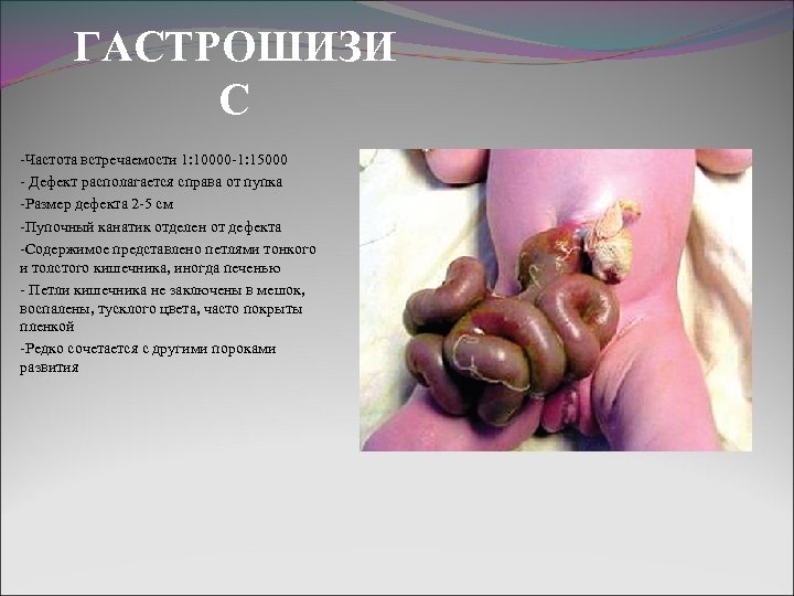 ГАСТРОШИЗИ С -Частота встречаемости 1: 10000 -1: 15000 - Дефект располагается справа от пупка