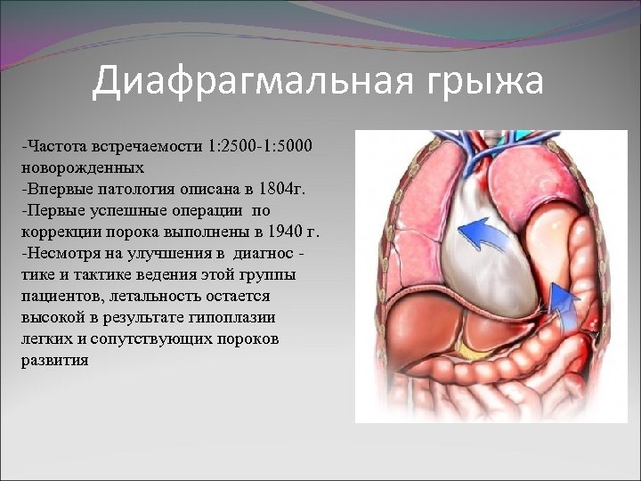 Диафрагмальная грыжа -Частота встречаемости 1: 2500 -1: 5000 новорожденных -Впервые патология описана в 1804