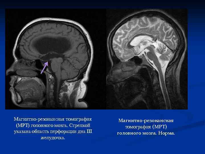 Магнитно-резонансная томография (МРТ) головного мозга. Стрелкой указана область перфорации дна III желудочка. Магнитно-резонансная томография