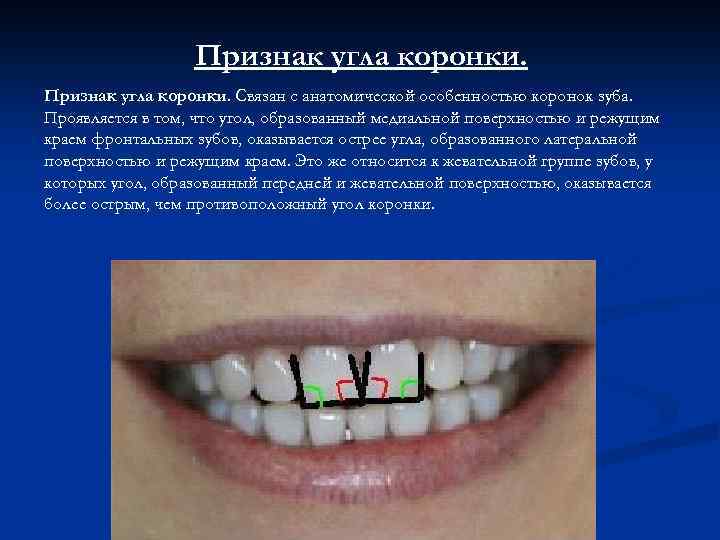 Признак угла коронки. Связан с анатомической особенностью коронок зуба. Проявляется в том, что угол,