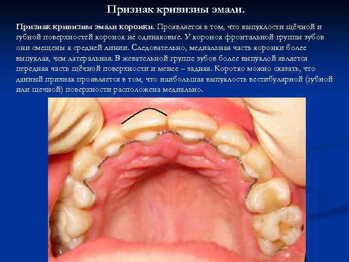 Признак кривизны эмали коронки. Проявляется в том, что выпуклости щёчной и губной поверхностей коронок