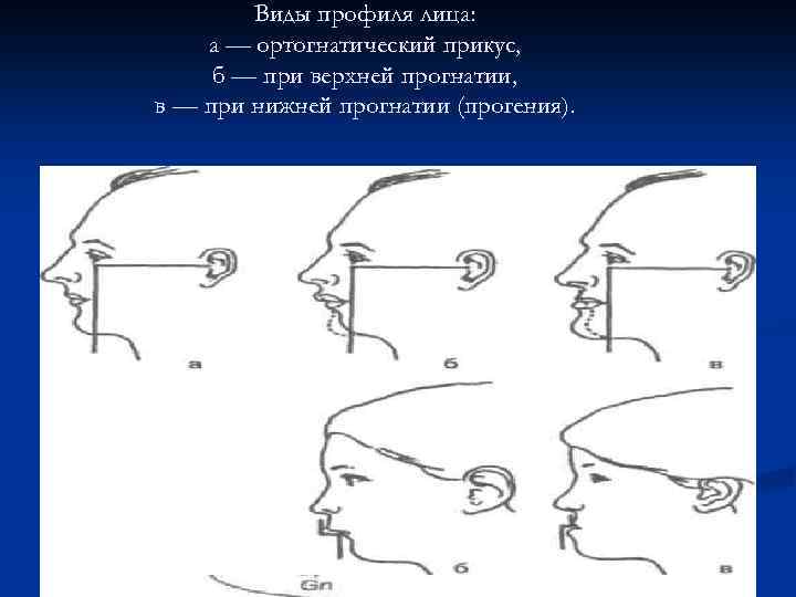 Виды профиля лица: а — ортогнатический прикус, б — при верхней прогнатии, в —