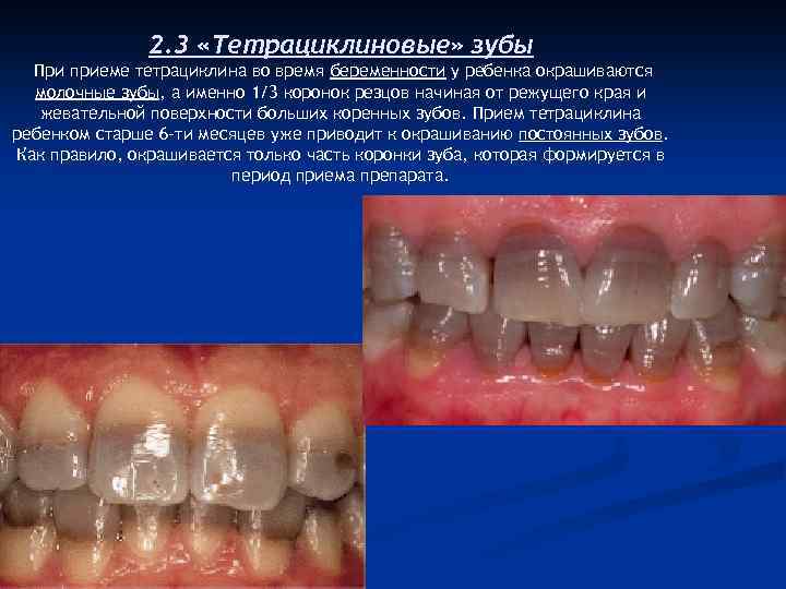 2. 3 «Тетрациклиновые» зубы При приеме тетрациклина во время беременности у ребенка окрашиваются молочные