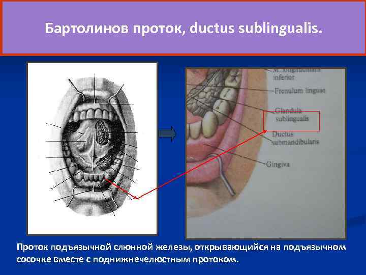 Бартолинов проток, ductus sublingualis. Проток подъязычной слюнной железы, открывающийся на подъязычном сосочке вместе с