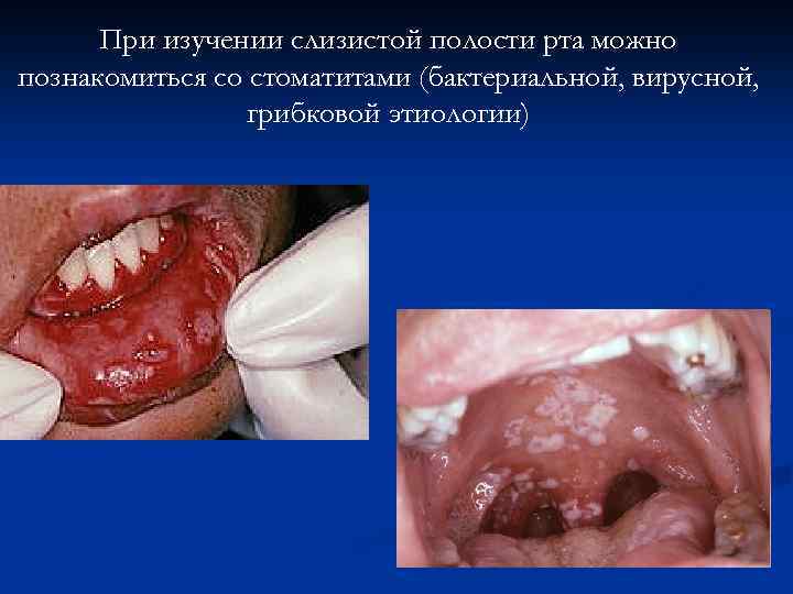 При изучении слизистой полости рта можно познакомиться со стоматитами (бактериальной, вирусной, грибковой этиологии) 