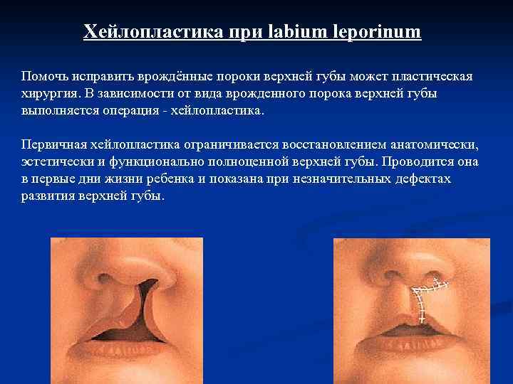 Хейлопластика при labium leporinum Помочь исправить врождённые пороки верхней губы может пластическая хирургия. В