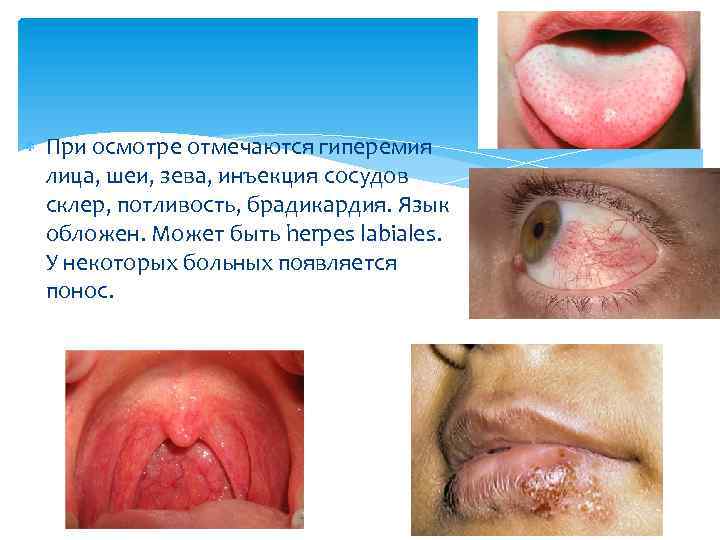  При осмотре отмечаются гиперемия лица, шеи, зева, инъекция сосудов склер, потливость, брадикардия. Язык