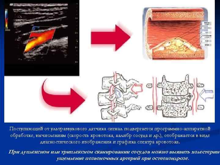 Поступающий от ультразвукового датчика сигнал подвергается программно-аппаратной обработке, вычислениям (скорость кровотока, калибр сосуда и