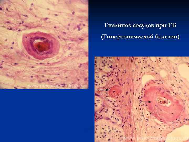 Гиалиноз сосудов при ГБ (Гипертонической болезни) 