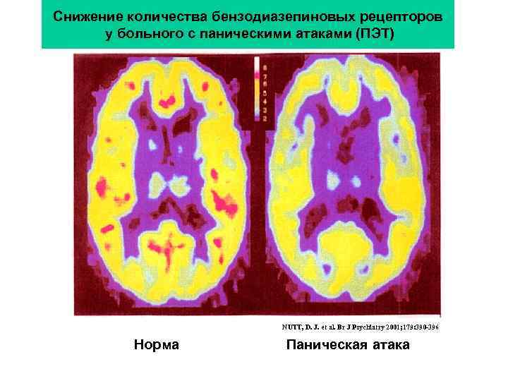 Снижение количества бензодиазепиновых рецепторов у больного с паническими атаками (ПЭТ) NUTT, D. J. et
