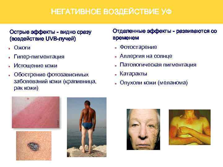 НЕГАТИВНОЕ ВОЗДЕЙСТВИЕ УФ Острые эффекты - видно сразу (воздействие UVB-лучей) Отдаленные эффекты - развиваются