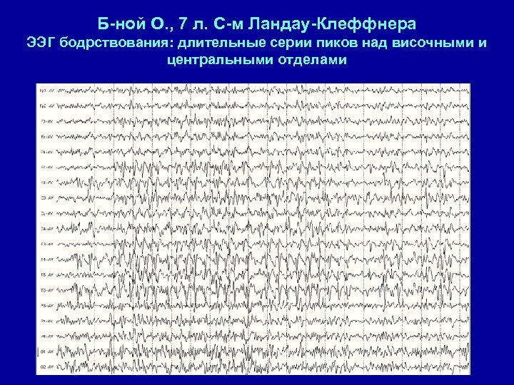Б-ной О. , 7 л. С-м Ландау-Клеффнера ЭЭГ бодрствования: длительные серии пиков над височными