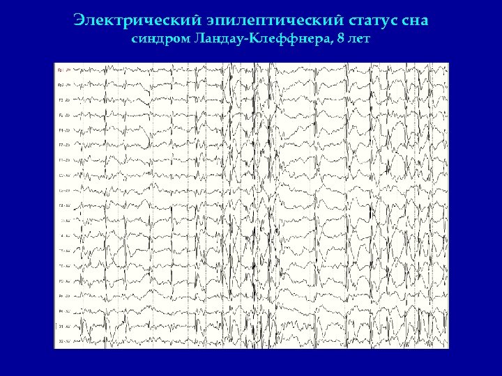 Электрический эпилептический статус сна синдром Ландау-Клеффнера, 8 лет 