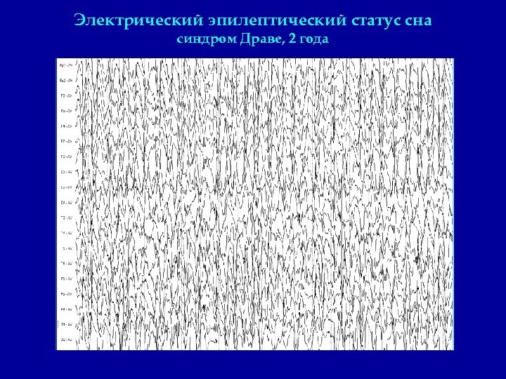 Электрический эпилептический статус сна синдром Драве, 2 года 