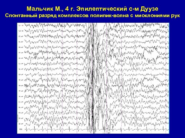 Мальчик М. , 4 г. Эпилептический с-м Дуузе Спонтанный разряд комплексов полипик-волна с миоклониями