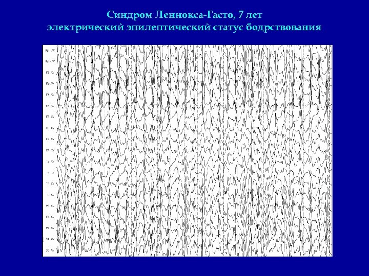 Синдром Леннокса-Гасто, 7 лет электрический эпилептический статус бодрствования 