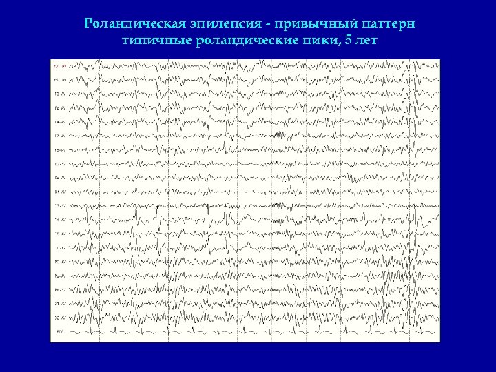 Роландическая эпилепсия - привычный паттерн типичные роландические пики, 5 лет 