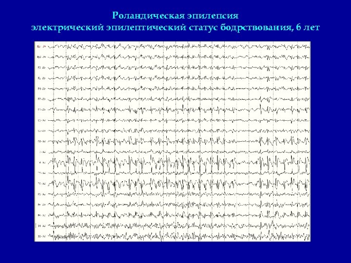 Роландическая эпилепсия электрический эпилептический статус бодрствования, 6 лет 