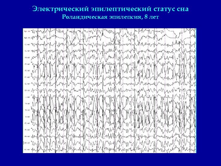 Электрический эпилептический статус сна Роландическая эпилепсия, 8 лет 