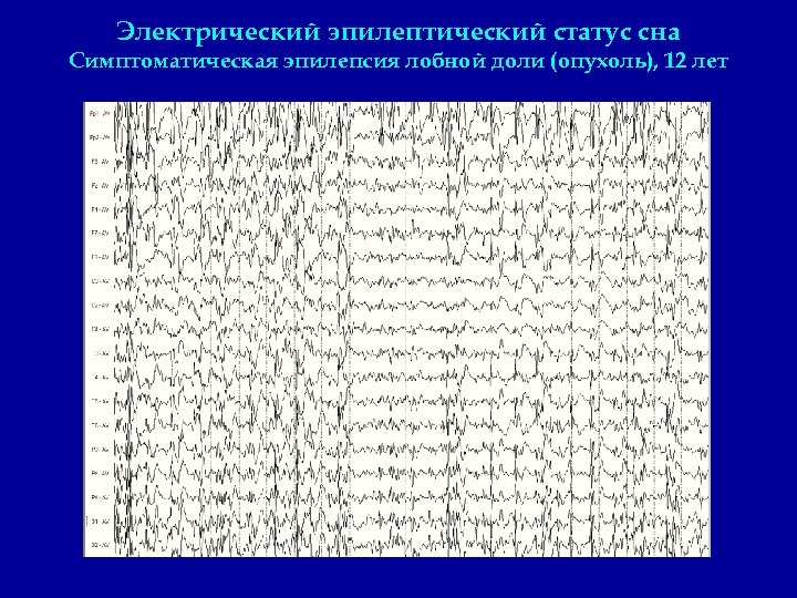 Электрический эпилептический статус сна Симптоматическая эпилепсия лобной доли (опухоль), 12 лет 