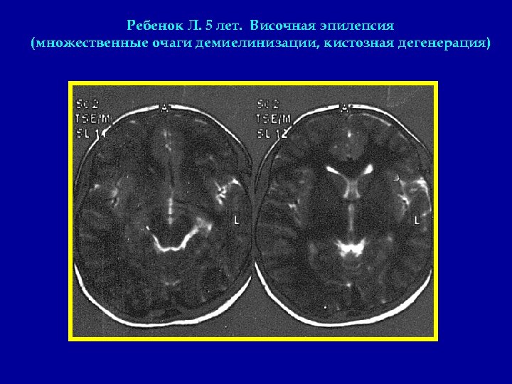 Ребенок Л. 5 лет. Височная эпилепсия (множественные очаги демиелинизации, кистозная дегенерация) 