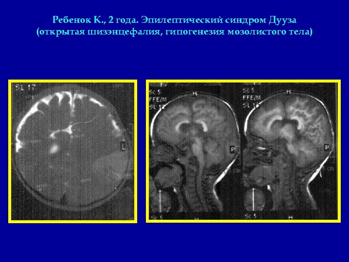 Ребенок К. , 2 года. Эпилептический синдром Дууза (открытая шизэнцефалия, гипогенезия мозолистого тела) 