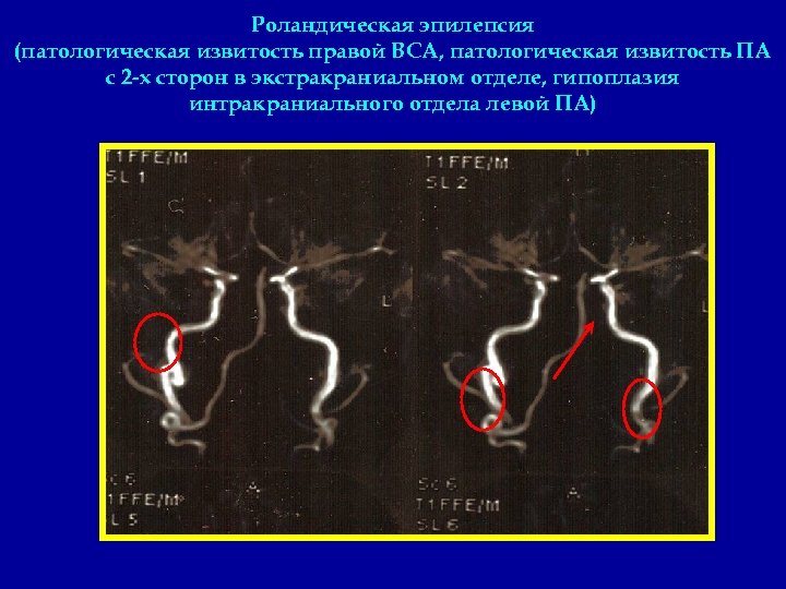 Роландическая эпилепсия (патологическая извитость правой ВСА, патологическая извитость ПА с 2 -х сторон в