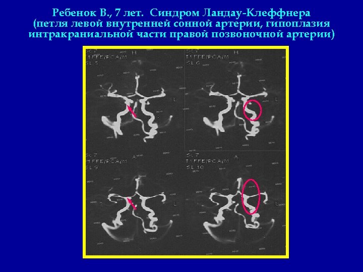 Ребенок В. , 7 лет. Синдром Ландау-Клеффнера (петля левой внутренней сонной артерии, гипоплазия интракраниальной