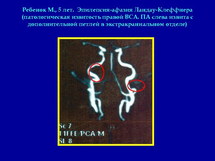 Ребенок М. , 5 лет. Эпилепсия-афазия Ландау-Клеффнера (патологическая извитость правой ВСА. ПА слева извита