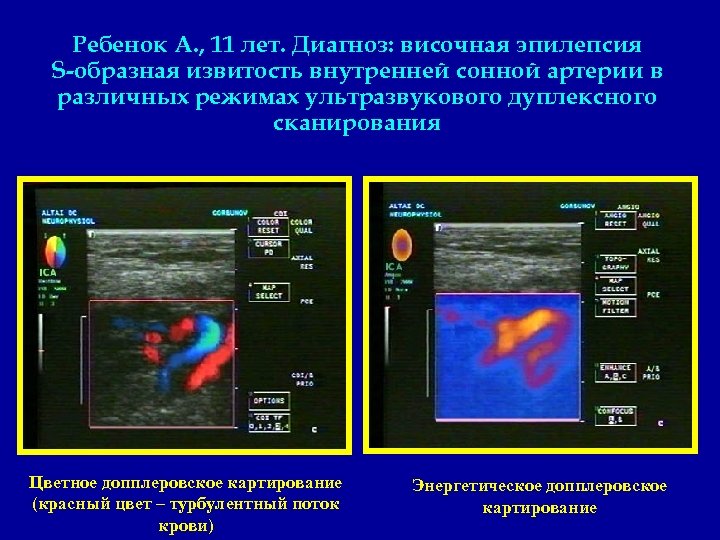 Ребенок А. , 11 лет. Диагноз: височная эпилепсия S-образная извитость внутренней сонной артерии в