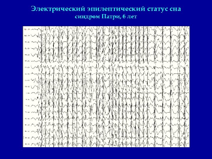 Электрический эпилептический статус сна синдром Патри, 6 лет 