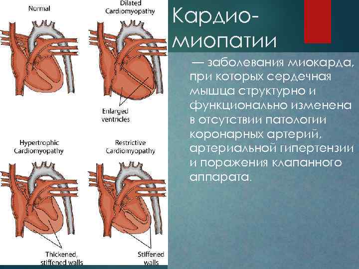 Кардио миопатии — заболевания миокарда, при которых сердечная мышца структурно и функционально изменена в