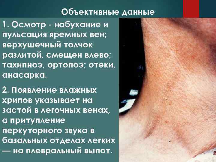 Объективные данные 1. Осмотр - набухание и пульсация яремных вен; верхушечный толчок разлитой, смещен