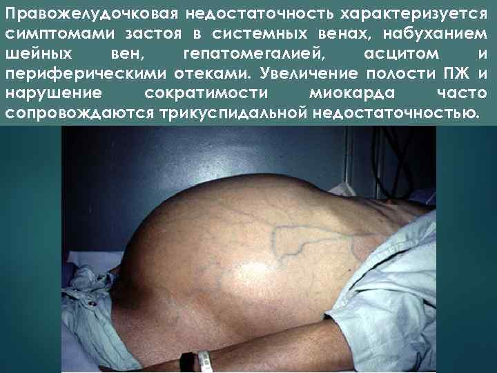Правожелудочковая недостаточность характеризуется симптомами застоя в системных венах, набуханием шейных вен, гепатомегалией, асцитом и