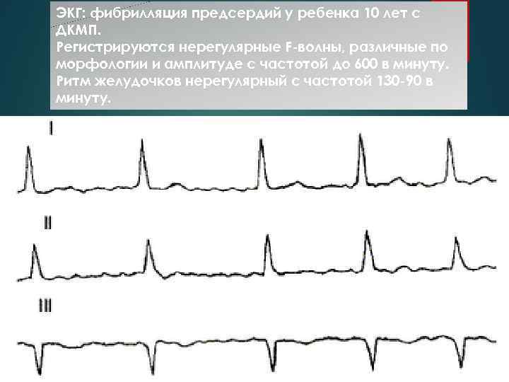 ЭКГ: фибрилляция предсердий у ребенка 10 лет с ДКМП. Регистрируются нерегулярные F-волны, различные по
