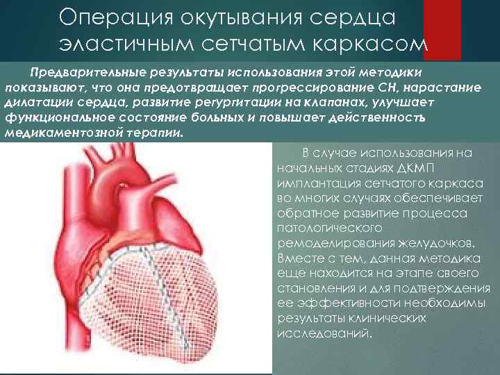 Операция окутывания сердца эластичным сетчатым каркасом Предварительные результаты использования этой методики показывают, что она