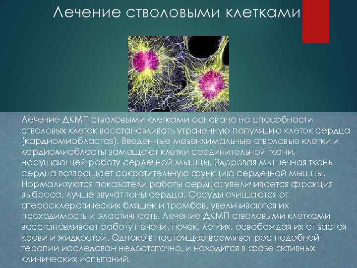 Лечение стволовыми клетками Лечение ДКМП стволовыми клетками основано на способности стволовых клеток восстанавливать утраченную