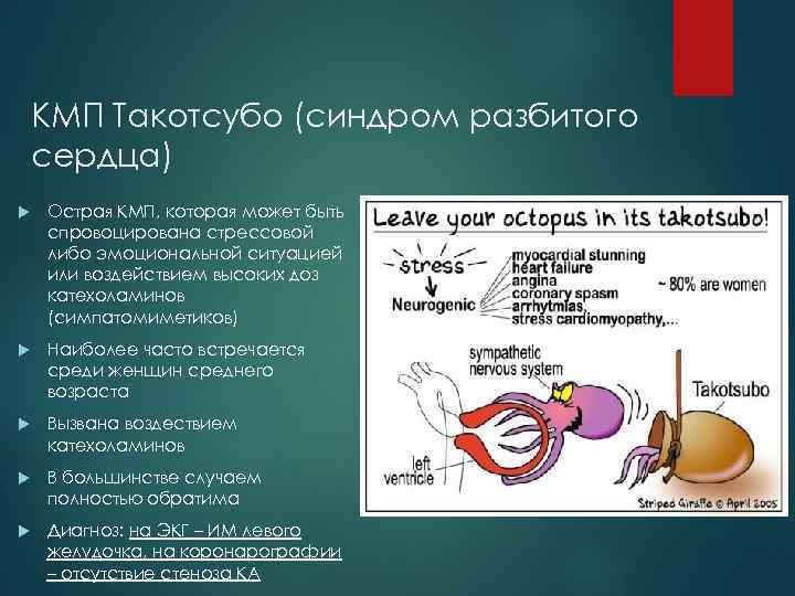 КМП Такотсубо (синдром разбитого сердца) Острая КМП, которая может быть спровоцирована стрессовой либо эмоциональной