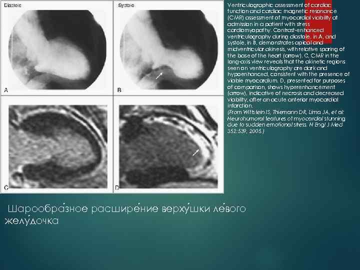 Ventriculographic assessment of cardiac function and cardiac magnetic resonance (CMR) assessment of myocardial viability