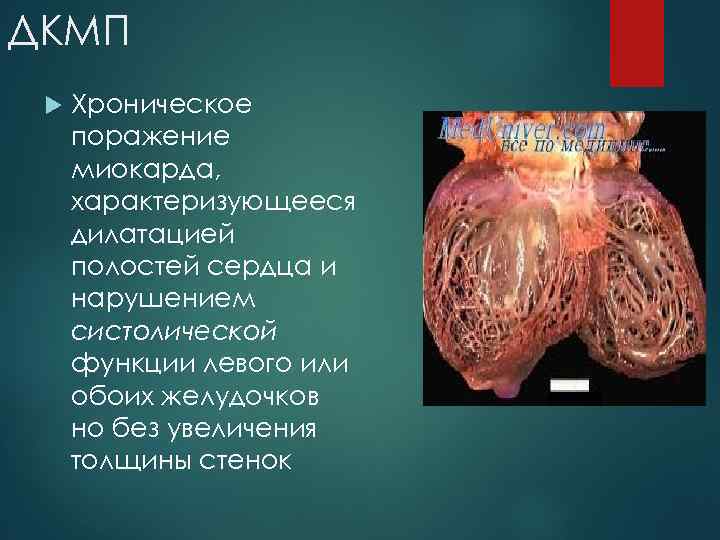 ДКМП Хроническое поражение миокарда, характеризующееся дилатацией полостей сердца и нарушением систолической функции левого или