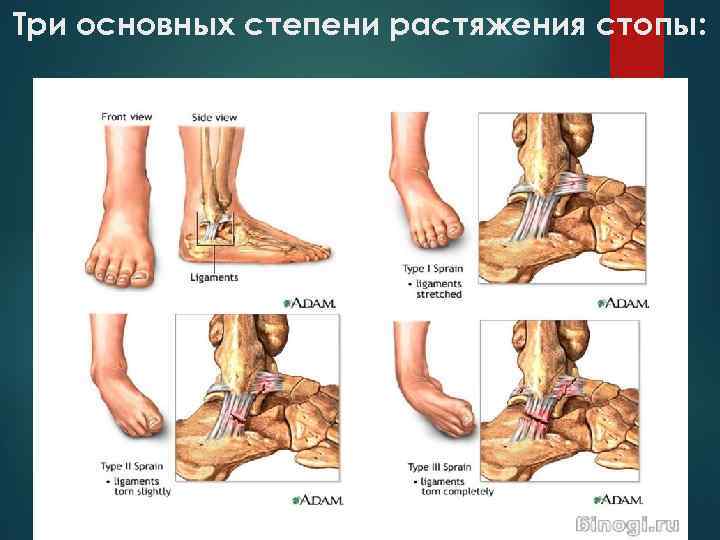 Три основных степени растяжения стопы: 