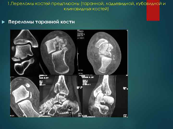 1. Переломы костей предплюсны (таранной, ладьевидной, кубовидной и клиновидных костей) Переломы таранной кости 