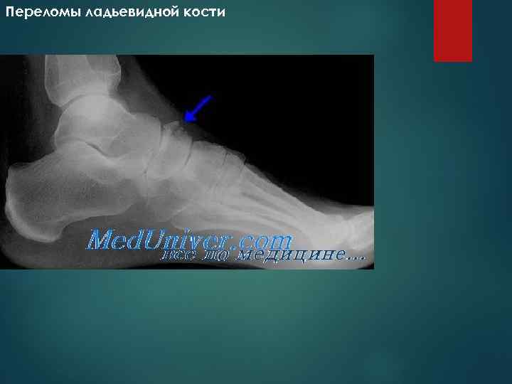 Переломы ладьевидной кости 