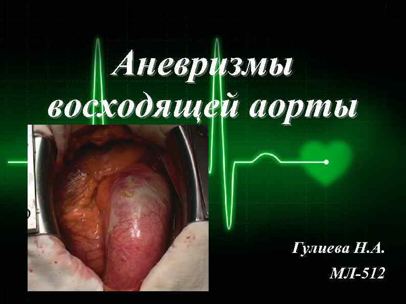 Аневризмы восходящей аорты Гулиева Н. А. МЛ-512 