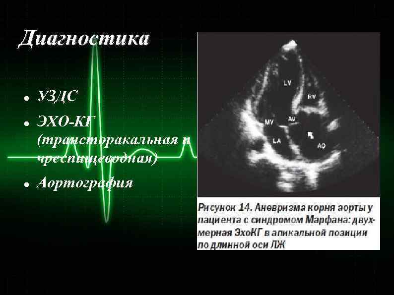 Диагностика УЗДС ЭХО-КГ (трансторакальная и чреспищеводная) Аортография 