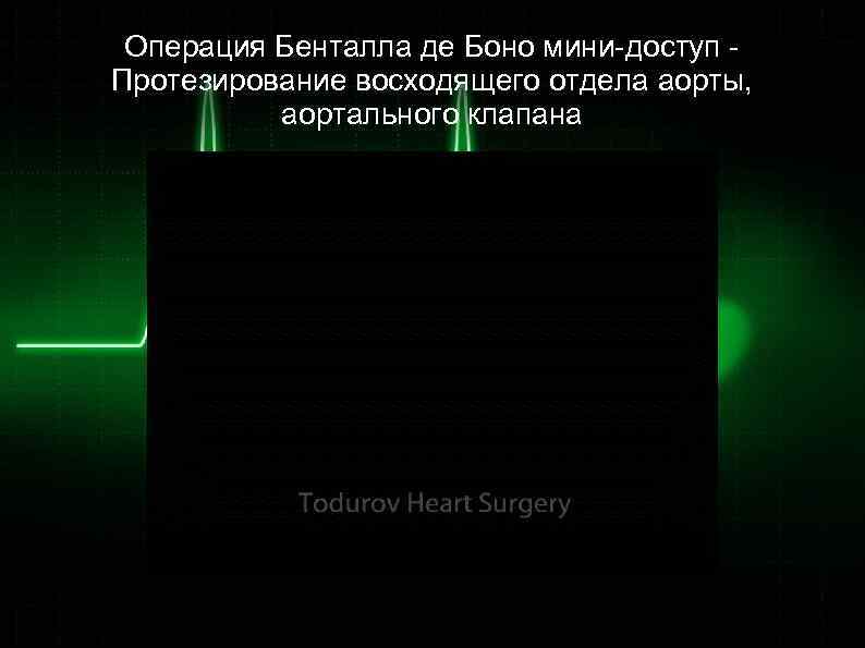 Операция Бенталла де Боно мини-доступ Протезирование восходящего отдела аорты, аортального клапана 