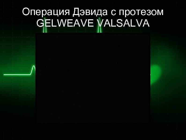 Операция Дэвида с протезом GELWEAVE VALSALVA 