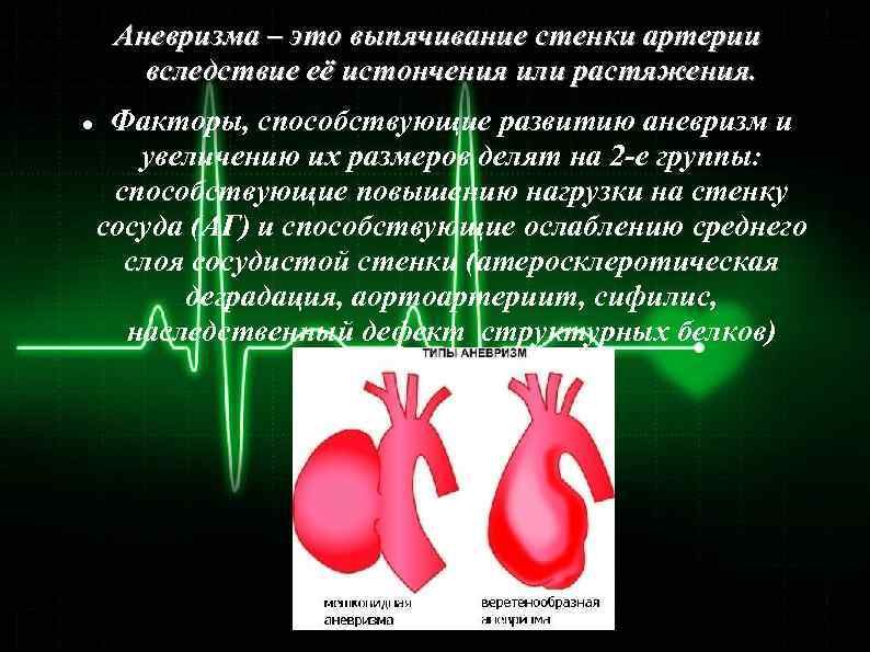 Аневризма – это выпячивание стенки артерии вследствие её истончения или растяжения. Факторы, способствующие развитию