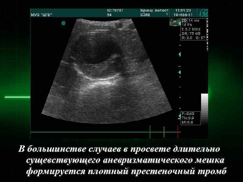 В большинстве случаев в просвете длительно сущевствующего аневризматического мешка формируется плотный престеночный тромб 